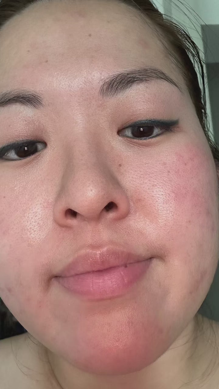 Rosacea relief
